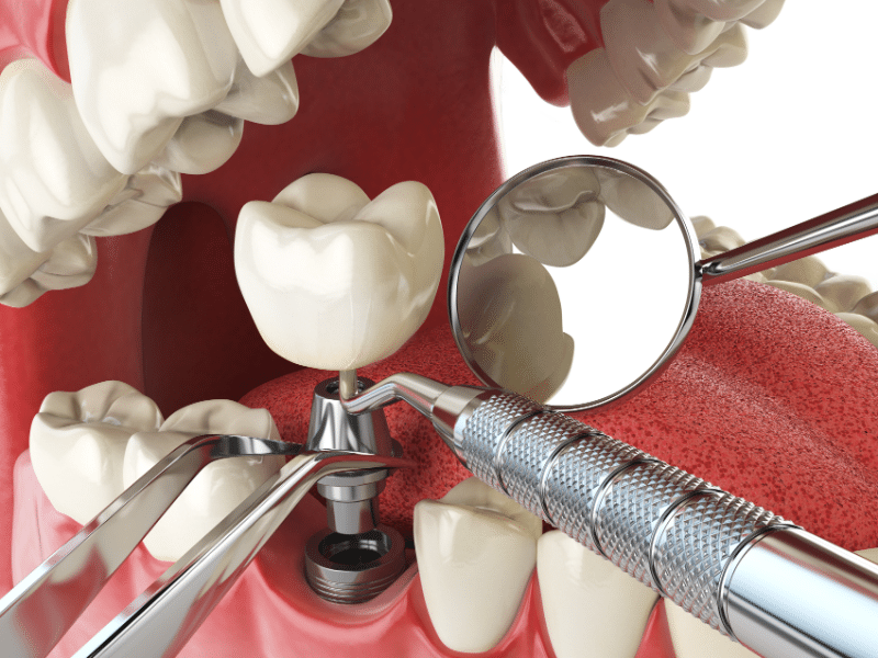 Dental implant nedir