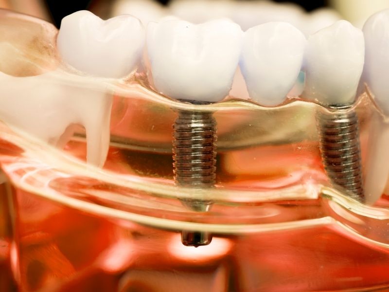 Dental İmplant
