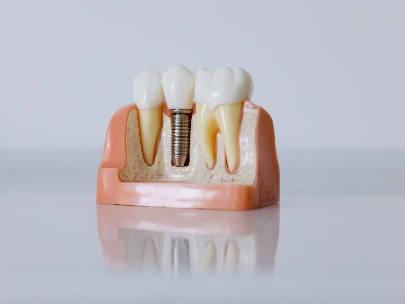dental implant tedavisi