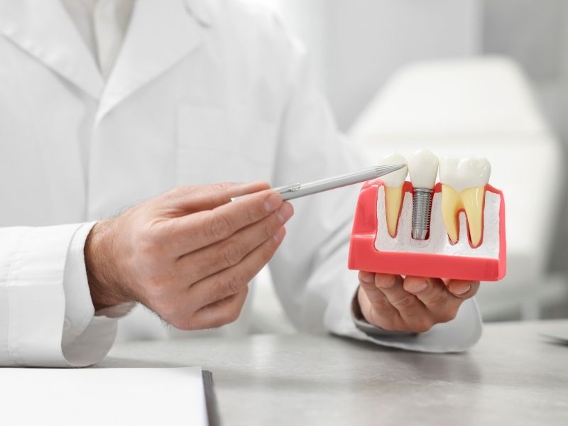 dental implant kimler için