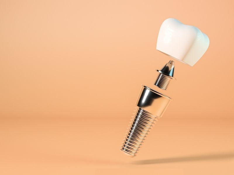 titanyum implant