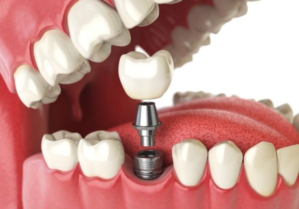 dental-implant (1) dental implant