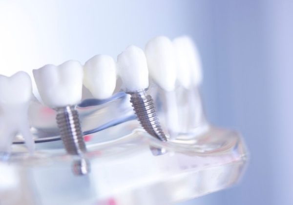dental-implant (2) dental implantta yaş sınırlaması
