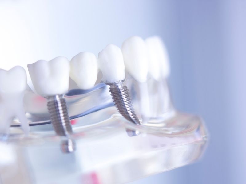dental implantta yaş sınırlaması