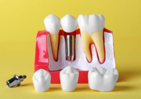 dental-implant (3) dental implant