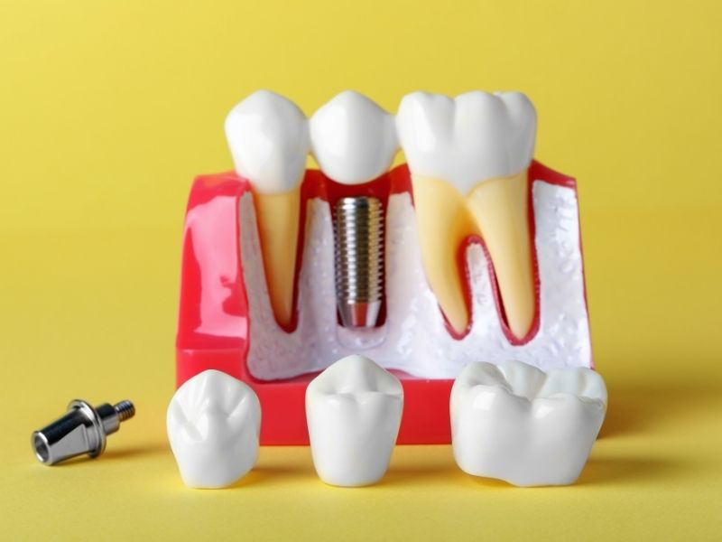dental-implant (3) dental implant