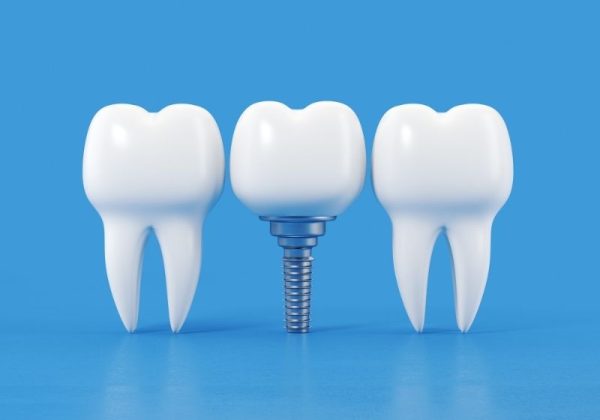 dis-cekimi-ve-dental-implant diş çekimi ve dental implant