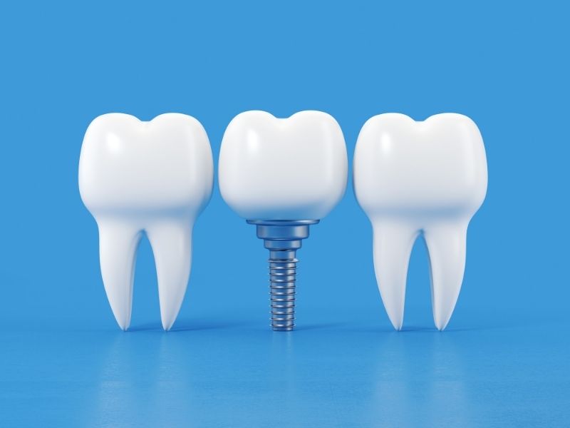 dis-cekimi-ve-dental-implant diş çekimi ve dental implant